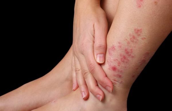 Nhân Sâm Bồ Công Anh hỗ trợ trị ngứa toàn thân